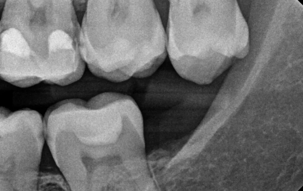 Radiograph of the mandibular left posterior teeth for the sample case